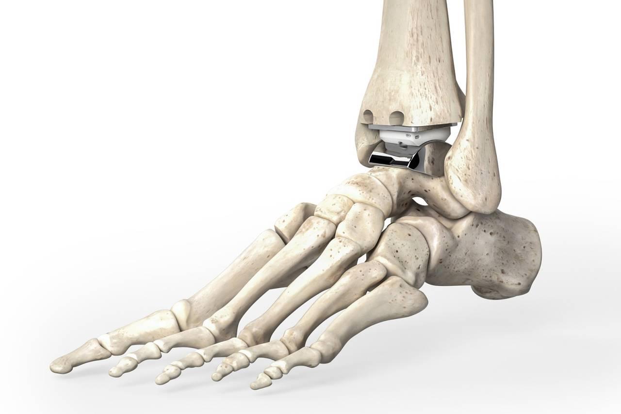 Ankle Replacement or Fusion? Columbia Orthopedic Surgery